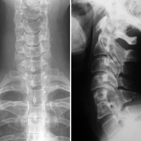 საშვილოსნოს ყელის ხერხემლის x -ray
