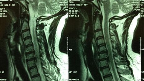 საშვილოსნოს ყელის განყოფილების MRI