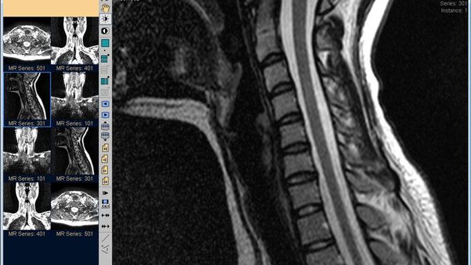 საშვილოსნოს ყელის ხერხემლის MRI საუკეთესო მეთოდია კისრის ტკივილის დიაგნოსტიკისთვის